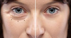 Woman before and after droopy eyelid surgery result.