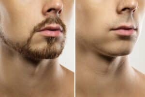 Before and after results of reconstructive beard and mustache hair transplantation.