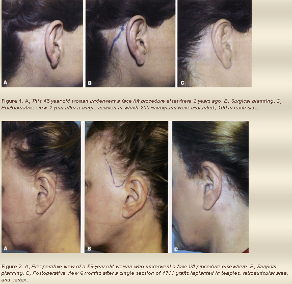 Correcting Hairline Deformity After Face Lift