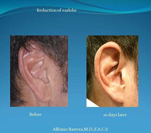 Ear Lobe Reduction